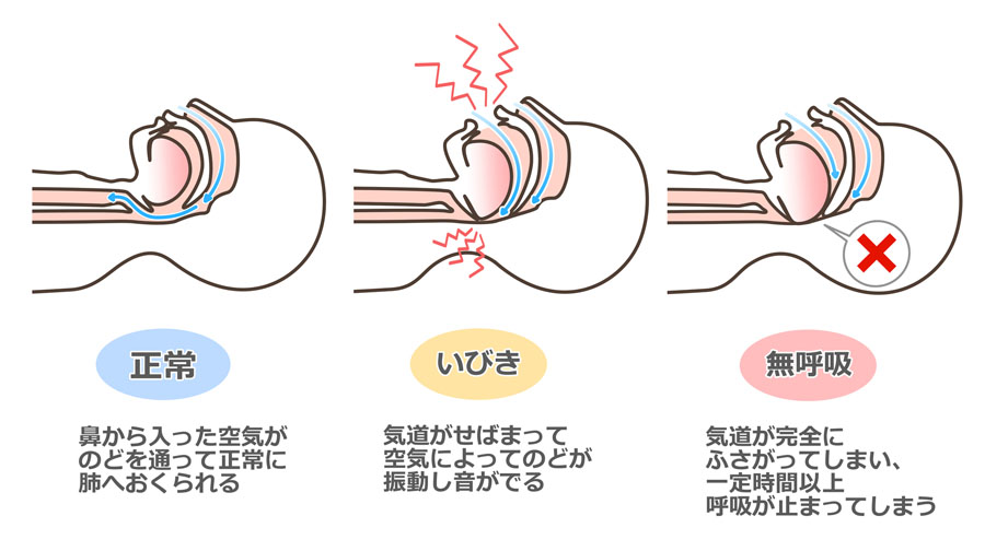 睡眠時無呼吸症候群になりやすい人の特徴